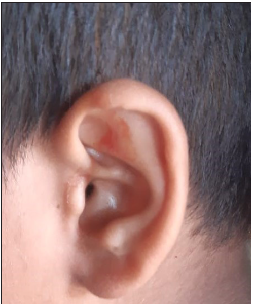 Sweat admixed with blood from the left ear pinna.
